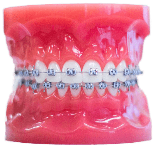 Metal Braces