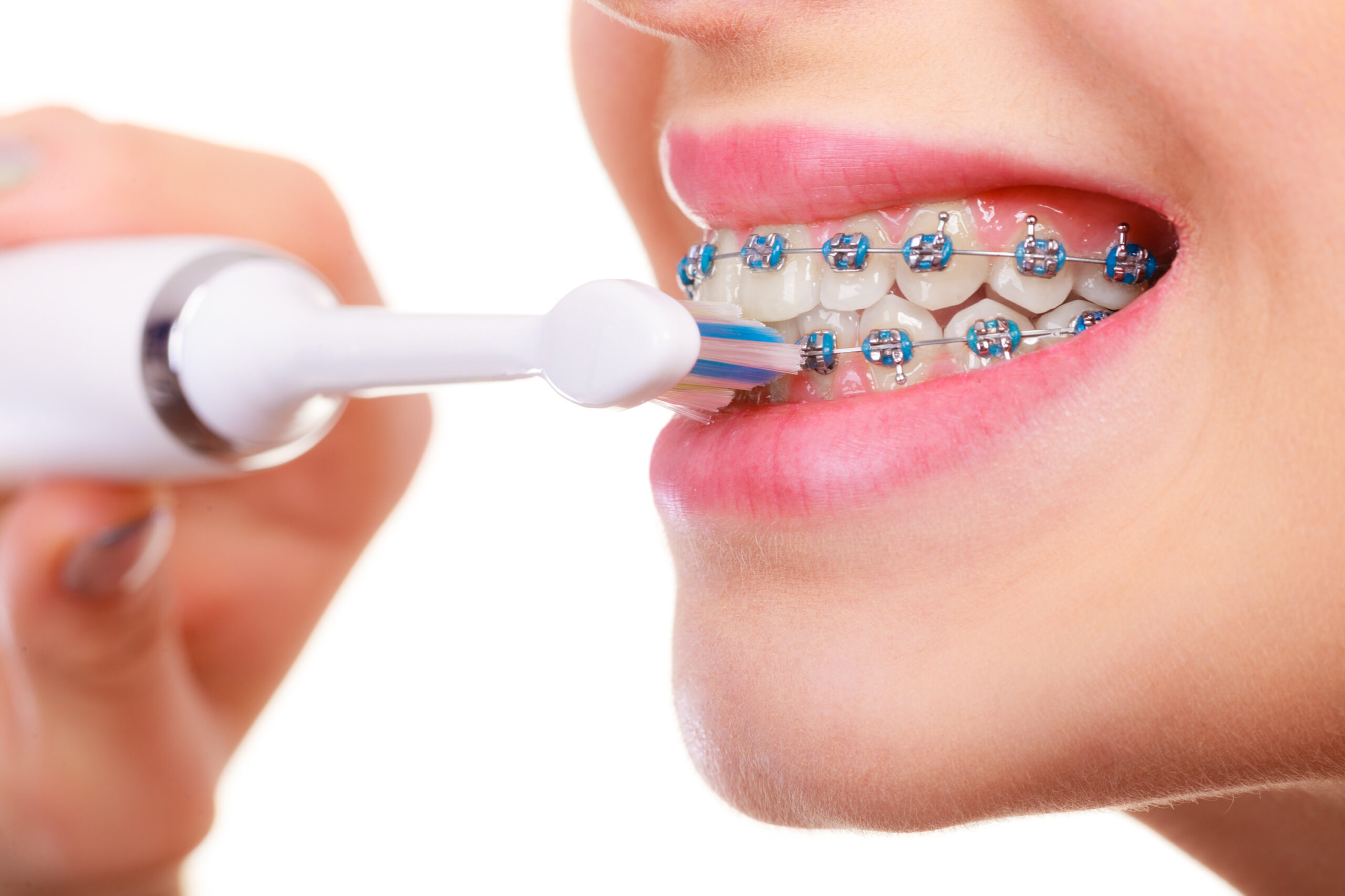 Woman brushing teeth with braces using brush