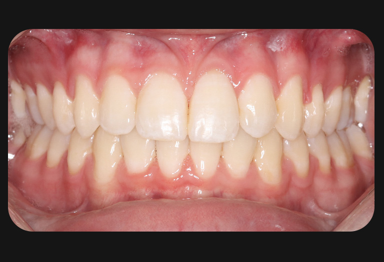 BK Intraoral-after-v2