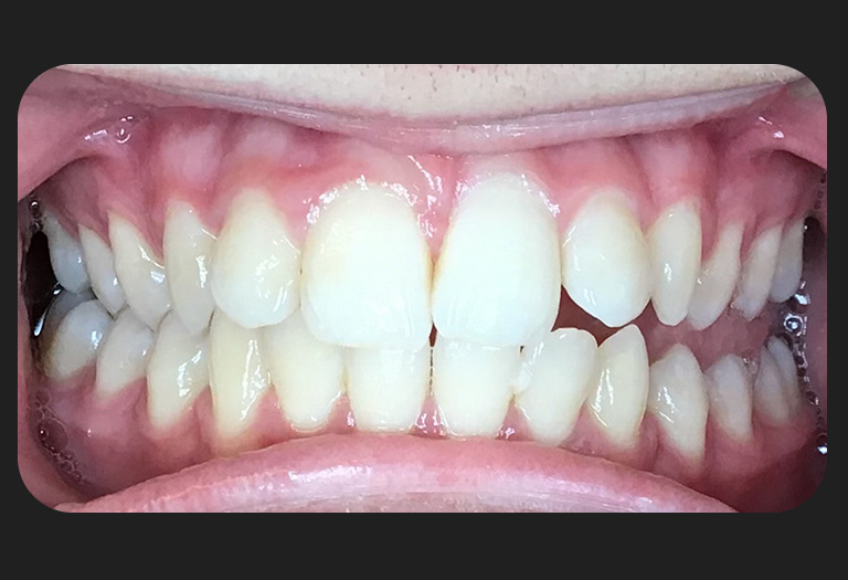 BK Intraoral-before-v3