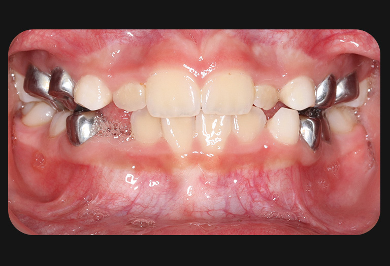 Cs intraoral after