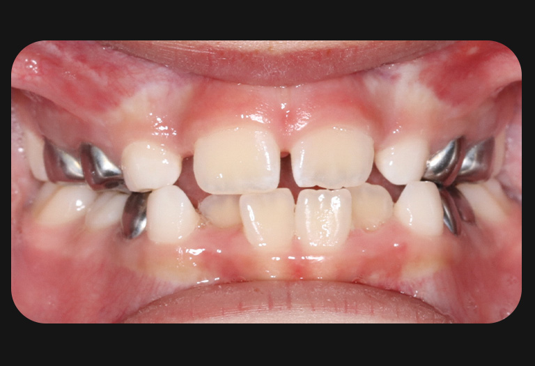 Cs intraoral before