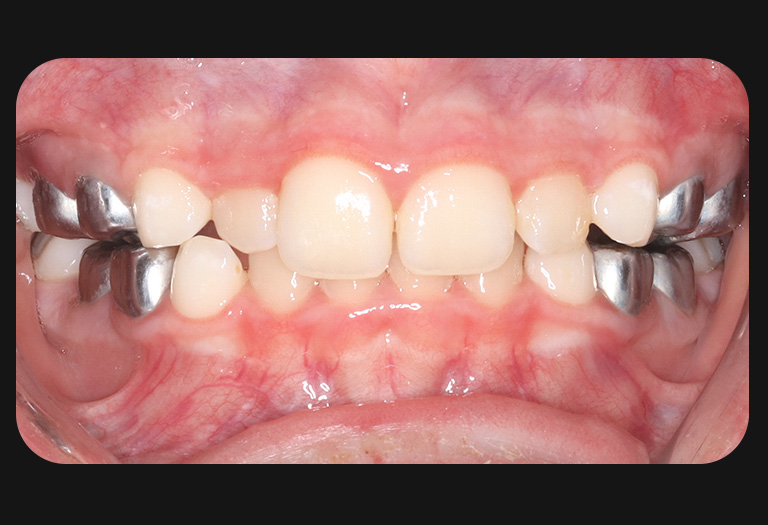 Gs intraoral after