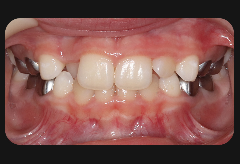 Gs intraoral before