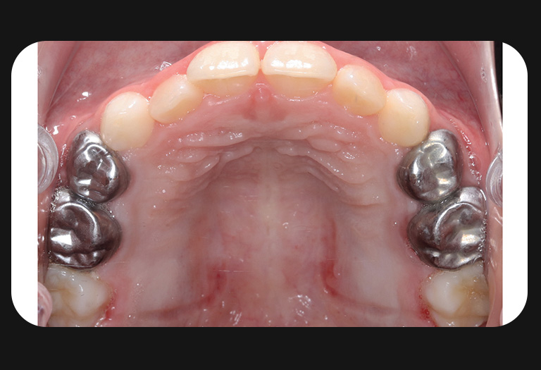 GS-Upper Arch-After