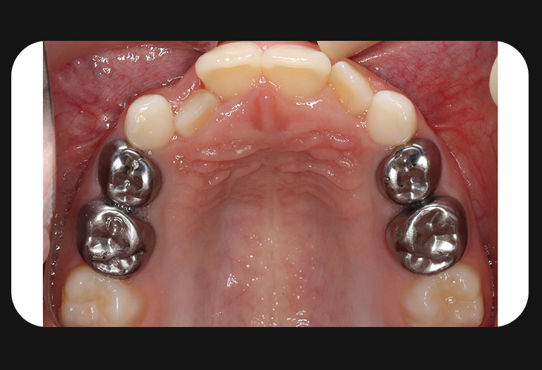 GS-Upper Arch-before