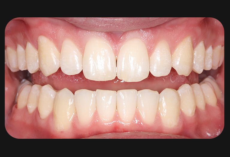 Ks intraoral after