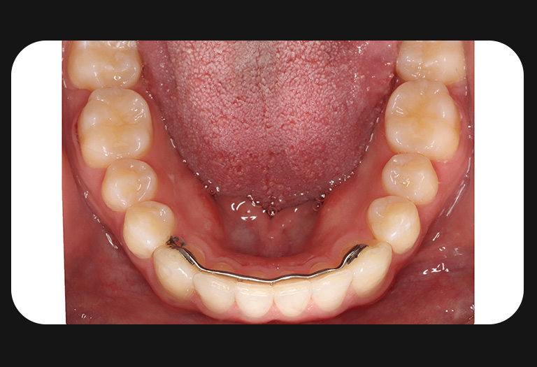 KS-Lower Arch-After