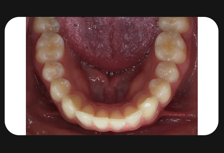 KS-Lower Arch-before