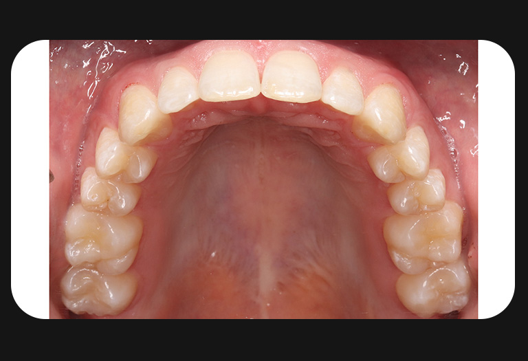 KS-Upper Arch-After