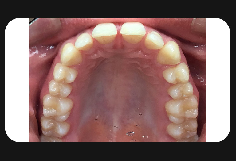 KS-Upper Arch-before