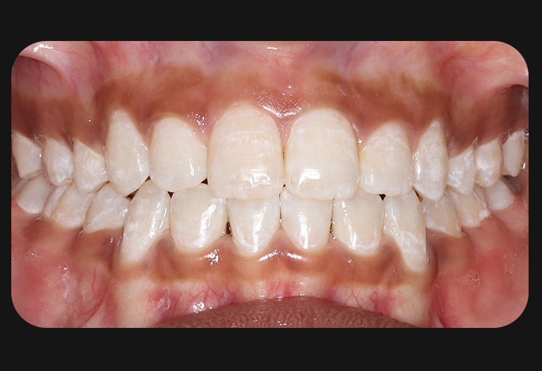 Ll intraoral after