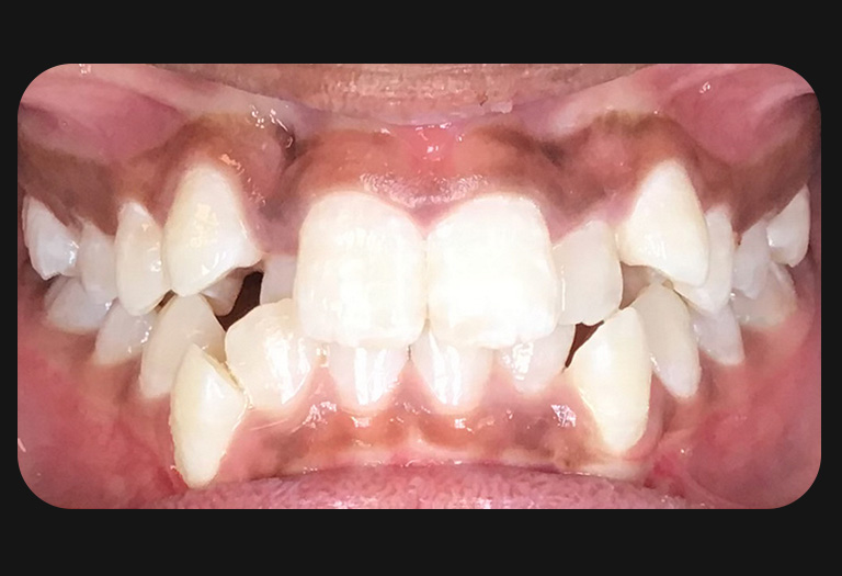 Ll intraoral before