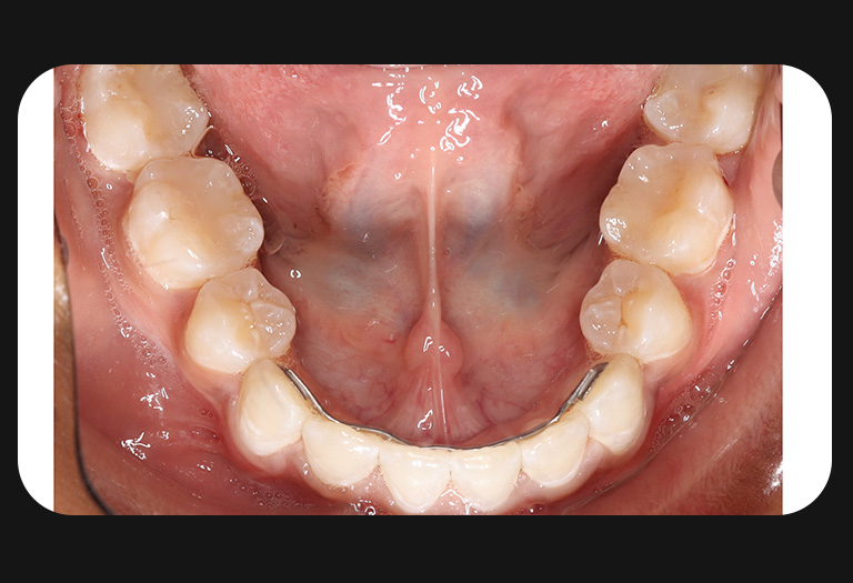 LL-Lower Arch-after
