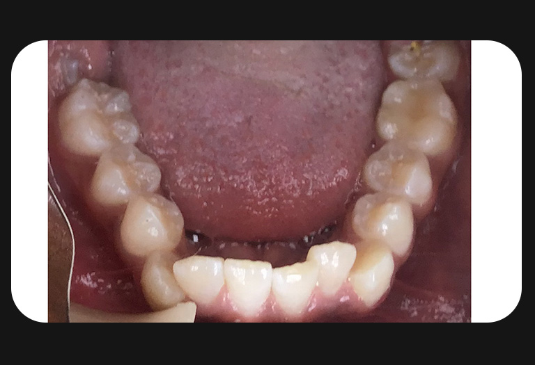 LL-Lower Arch-before