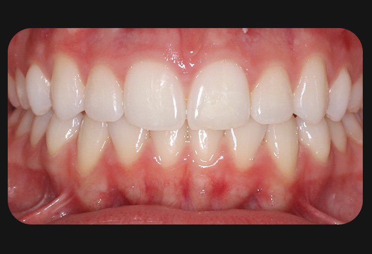 Nw intraoral after