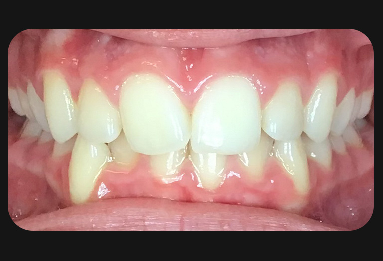 Nw intraoral before