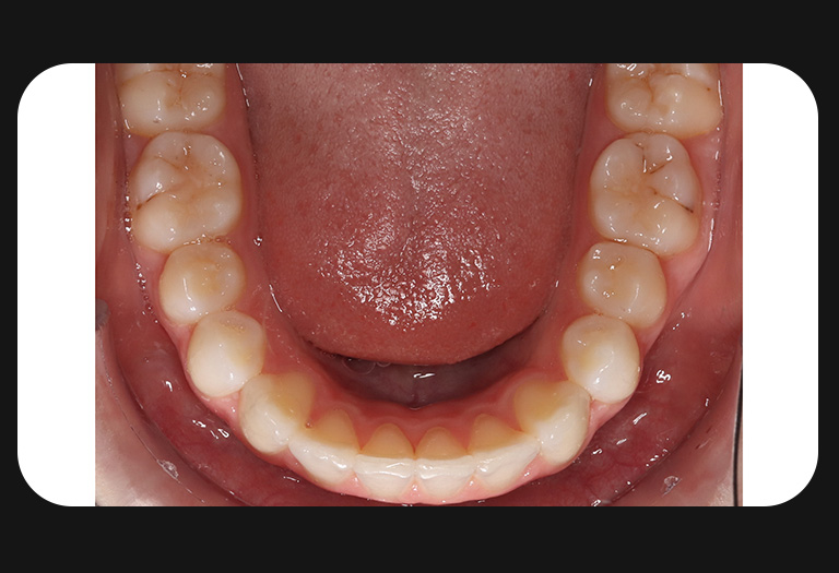 NW-Lower Arch-after