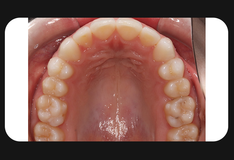 NW-Upper Arch-after