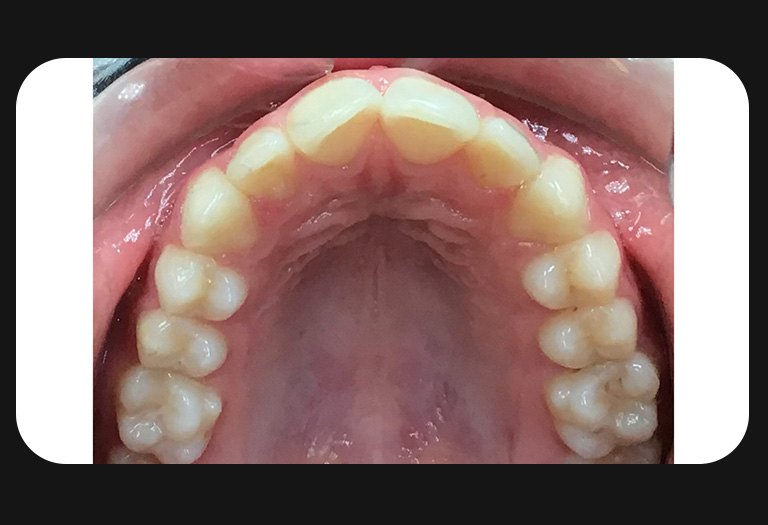 NW-Upper Arch-before