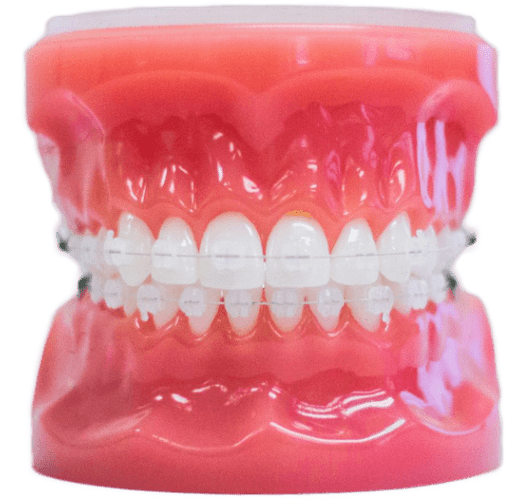 Clear Braces